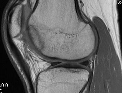 Femoral OCD Healing Post Drilling